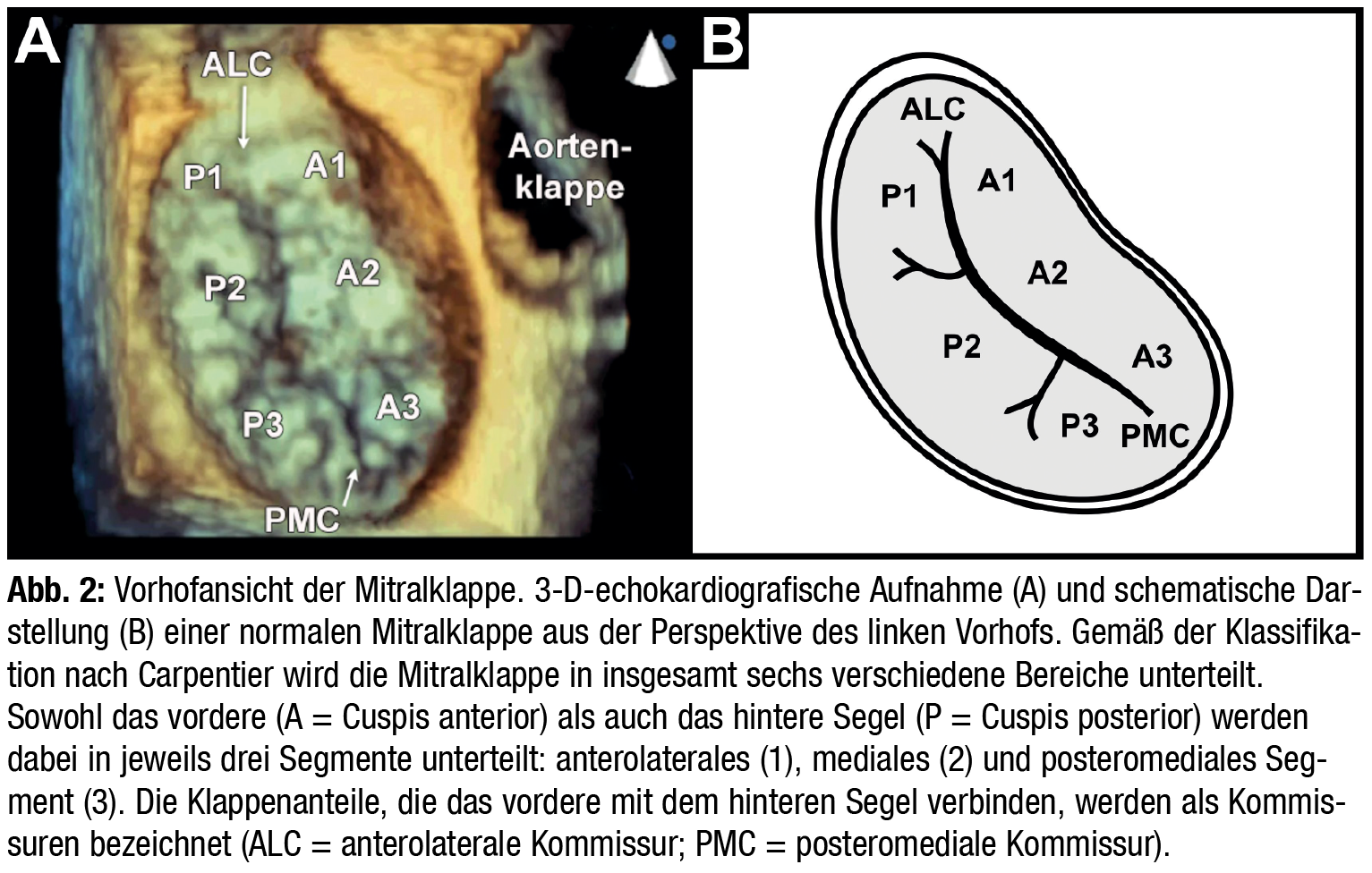 Krankheitsbilder der Mitralklappe: Mitralstenose und -insuffizienz ...